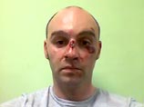 В ходе потасовки Кокорин получил серьезные травмы. Он в экстренном порядке был госпитализирован в понедельник: в моче появилась кровь, что возможно при сильном повреждении почек. Ранее у него были зафиксированы многочисленные ссадины лица, сотрясения мозг